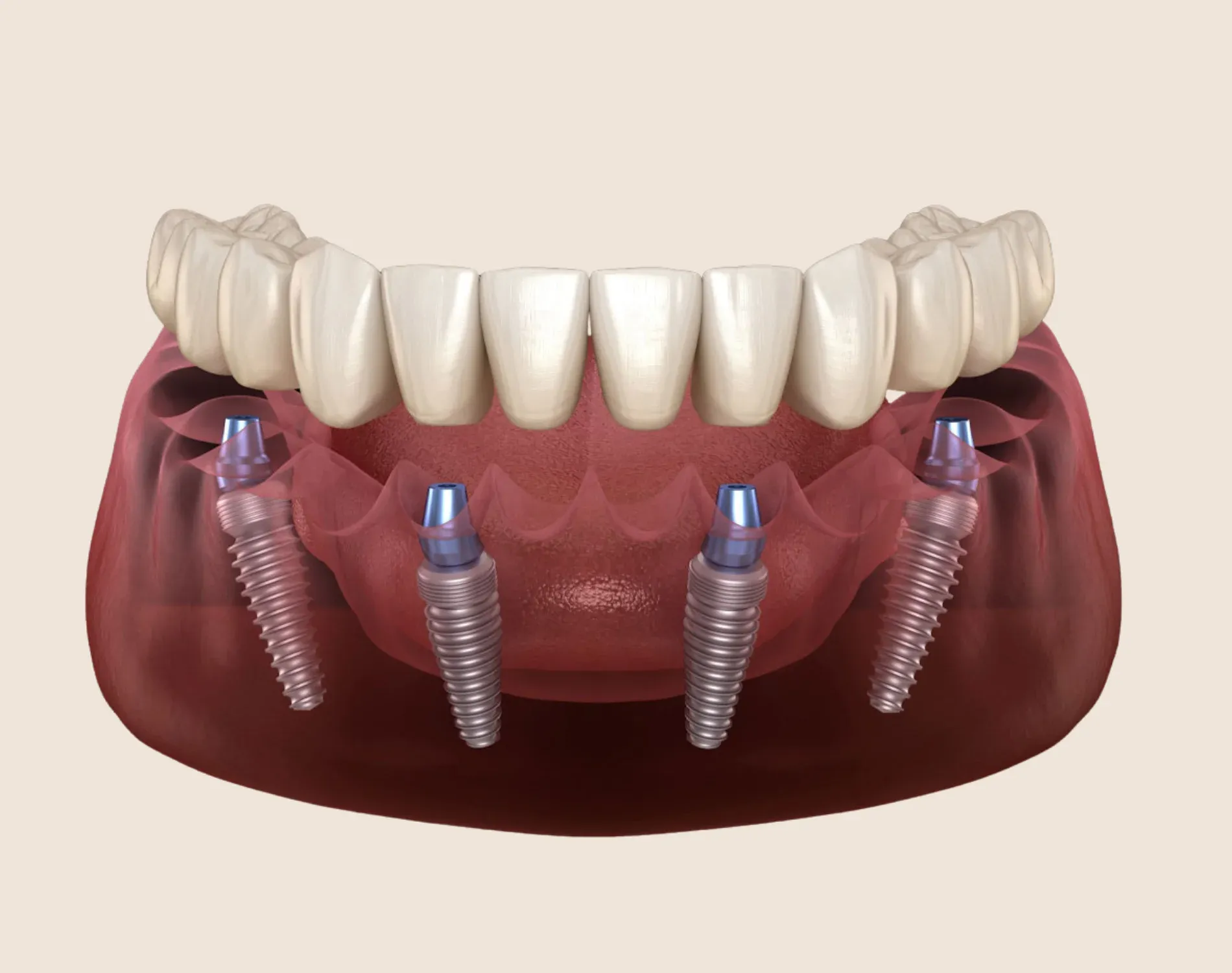 All-On-4 Dental Implants (All-on-X)