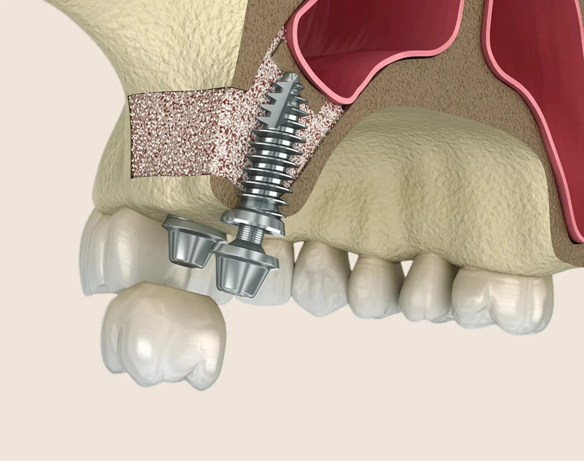 Oral Surgery Bone Grafting