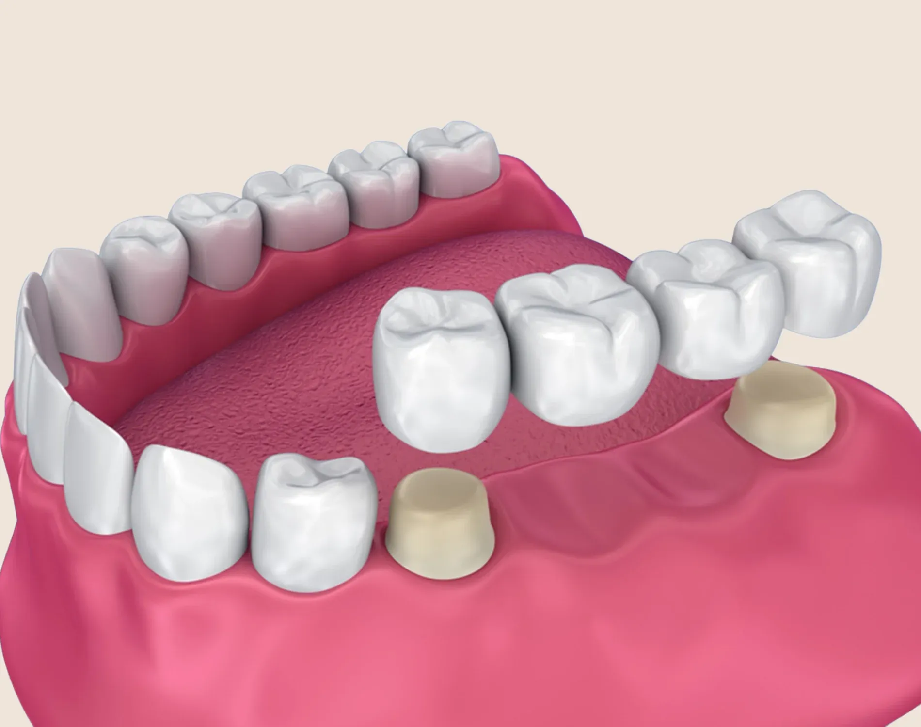 Dental Bridges