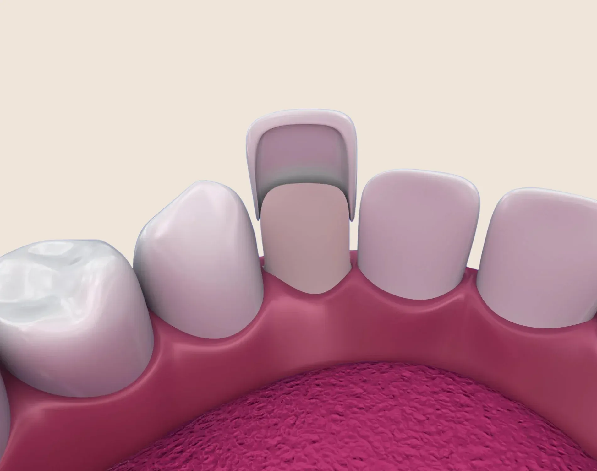 Porcelain Veneers