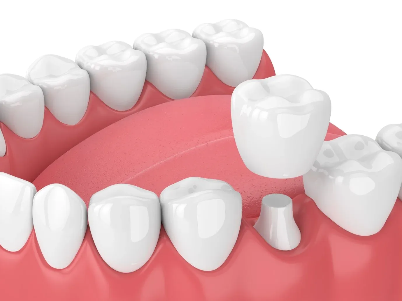 Same-Day Dental Crowns